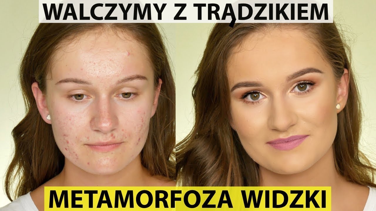 Makijaż Skóry Trądzikowej - Jak Ukrywać Niedoskonałości Bez Efektu 