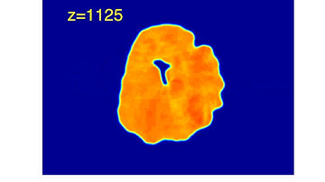 Encounter of a rarefaction pulse with a vortex-antivortex pair in liquid light