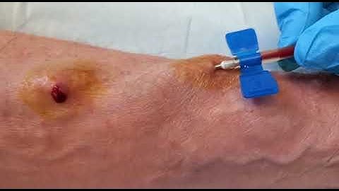 Buttonhole Needle insertion 1