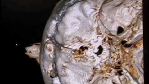3d Model of a CT Scanned Human Head