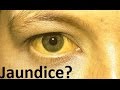 How serious is jaundice? - YouTube