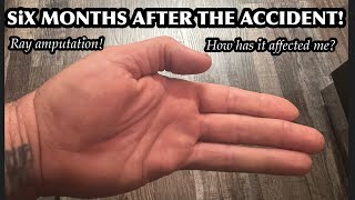 Ray Amputation 6 Month Update. How Has It Changed My Life? What Obstacles Has It Presented?