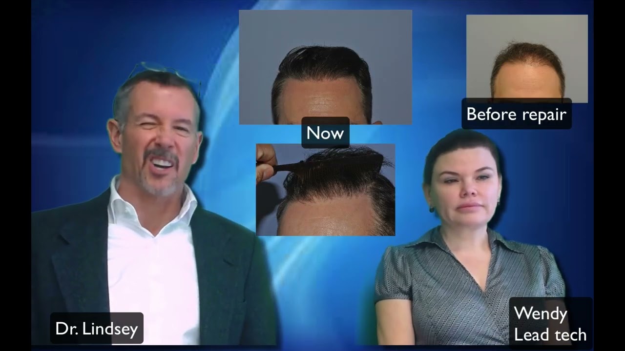 Another great hair transplant repair at 5 years by Dr. Lindsey in Washington | DC | Virginia