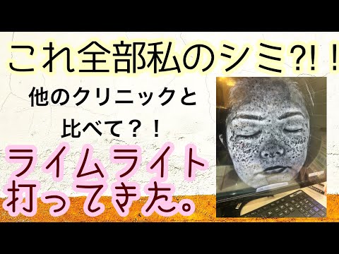 ライムライト　レーザー治療のレポート1週間の変化写真もあるよ！
