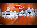 How braces are put on  step by step