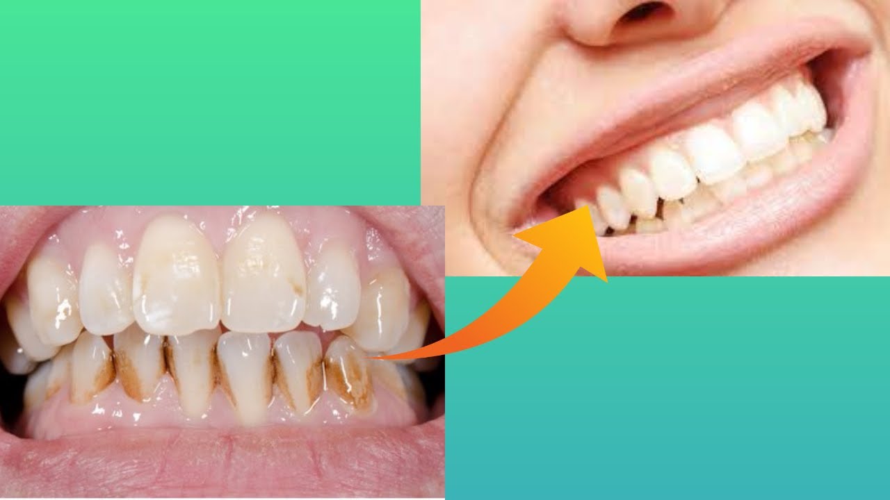 Teeth whitening at home in 3 minutes How to naturally whiten your