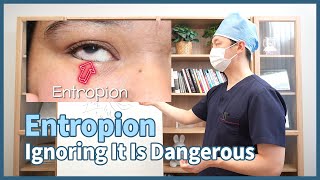 Entropion Can Be Dangerous If Left Untreated