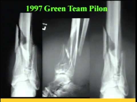 Pilon Fractures Management Options