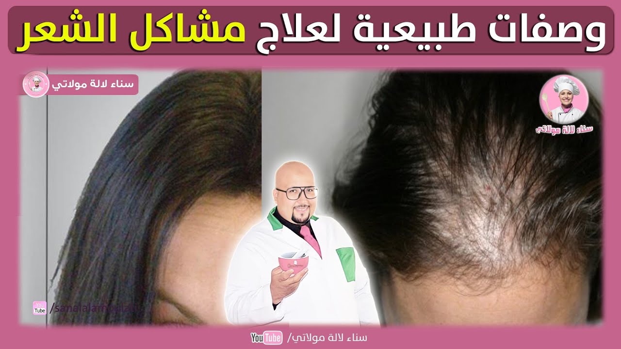 وصفات طبيعية للشعر من عند الدكتور عماد ميزاب : ترميم فروة الراس - تساقط الشعر - الشيب - الصدفية