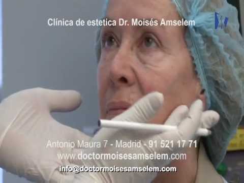 botox meaning Lifting facial no quirúrgico con Radiesse