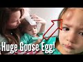 GIANT HEMATOMA ON TODDLER'S HEAD APPEARS AFTER PLAYING IN THE LOFT / TODDLER FORMS INSTANT GOOSE EGG