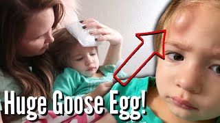 GIANT HEMATOMA ON TODDLER'S HEAD APPEARS AFTER PLAYING IN THE LOFT / TODDLER FORMS INSTANT GOOSE EGG