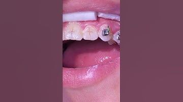 Orthodontic Bracket Repositioning -
