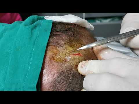 Sebacea cyst -Yağ kisti  saçlı deride