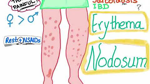 Welcher Arzt behandelt Erythema nodosum?