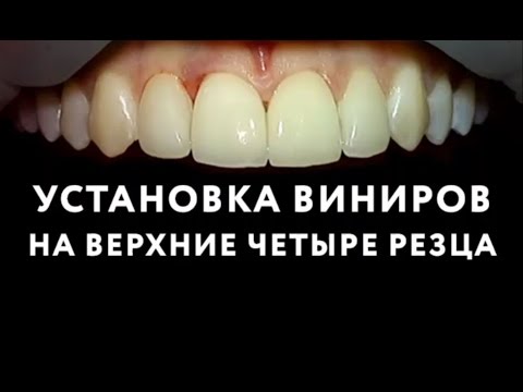 Виниры на зубы в Москве. Установка виниров на передние зубы