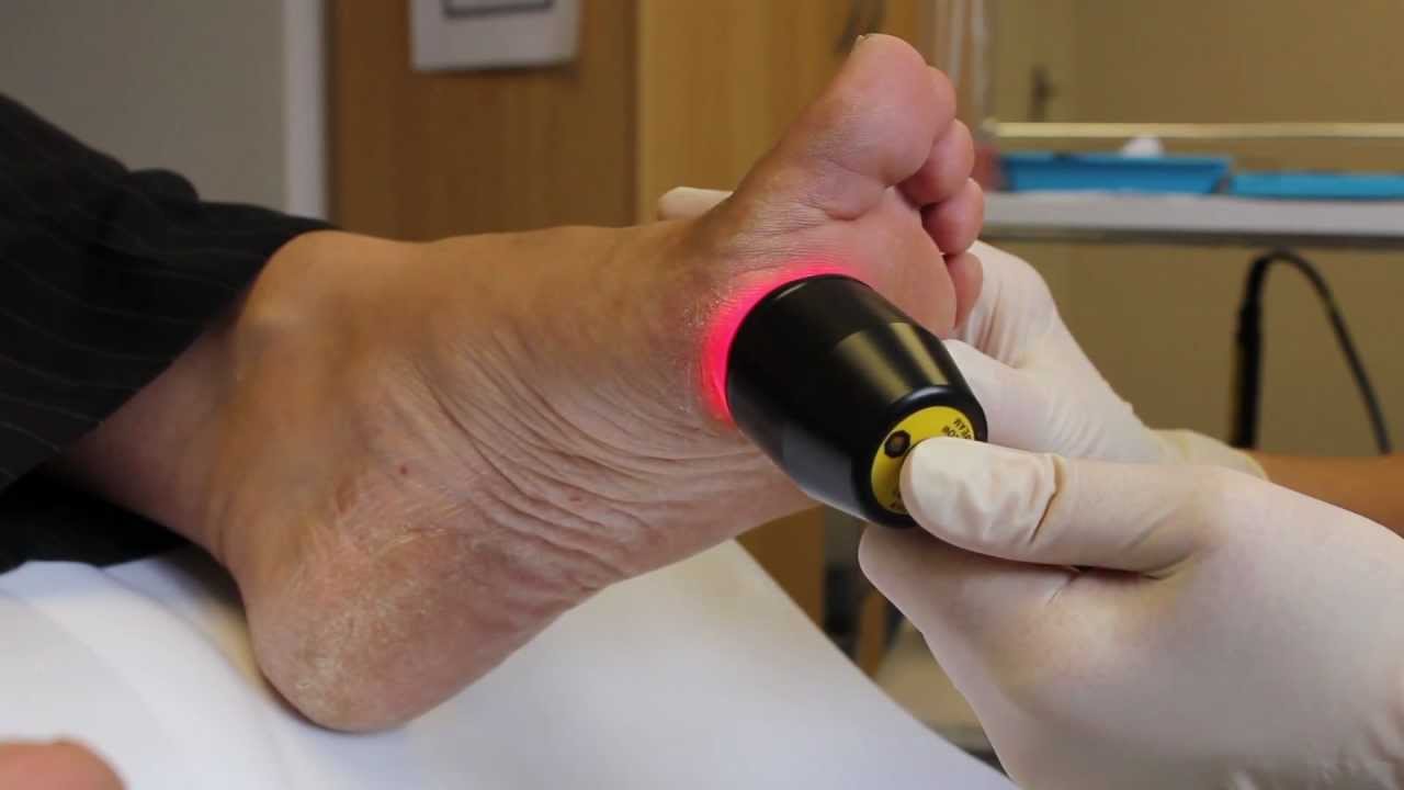 Laser Foot Treatment YouTube