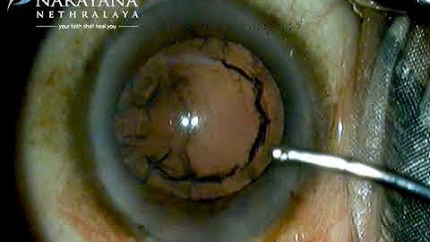 Phaco with foldable IOL using "ZEISS OPMI LUMERA I" microscope