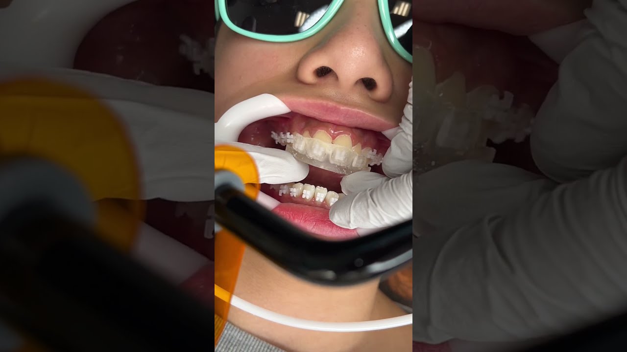 How Braces Are Put On