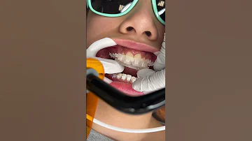 How Braces Are Put On 