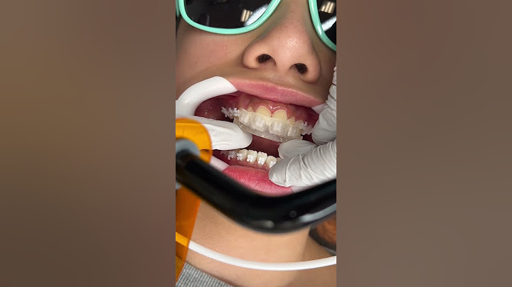 How Braces are Put On