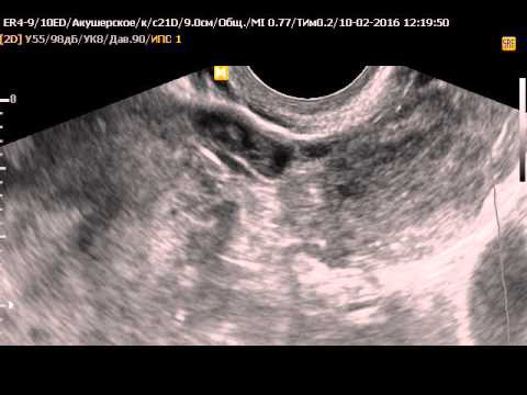 На узи видно внематочную. Внематочная беременность на УЗИ. УЗИ при внематочной беременности. Беременность в трубе на УЗИ. Внематочная беременность на УЗИ фото.