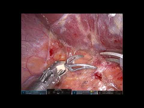 Robotic right liver mobilization