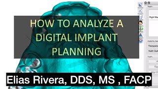 HOW TO ANALYZE A DIGITAL IMPLANT PLANNING by Dr. Elias Rivera