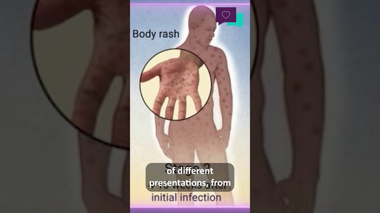 What Are The Signs Of Syphilis 