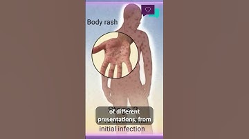 What are the signs of syphilis?