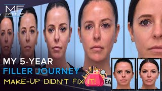 Full Face Filler Treatment Over 5 Years | Mabrie Facial Institute in San Francisco