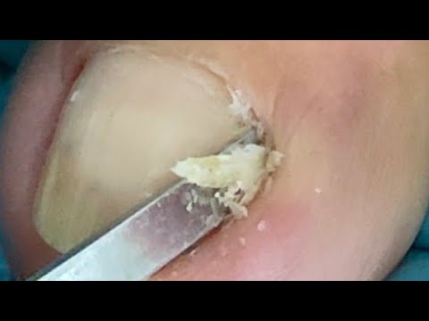 Painful Ingrown  Removal