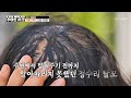 모자부터👒 가발까지💦 어떻게든 숨기고 싶은 고민🫣 탈모 TV CHOSUN 260523 방송 | [메디컬 스토리 주어진 시간] 15회 | TV조선