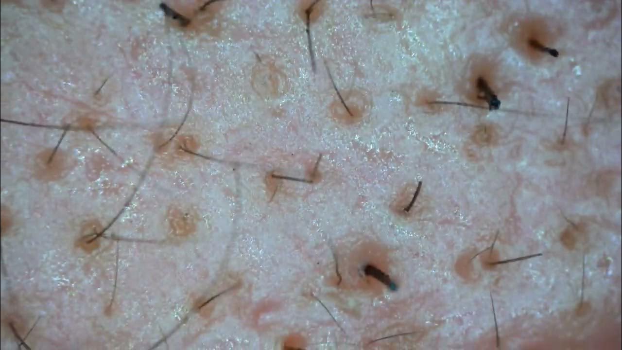 0198 keratin plug removal cheek YouTube