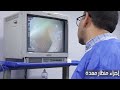 اجراء منظار المعده بالتفصيل وهل ممكن يحصل ثقب بالمعده نجومي