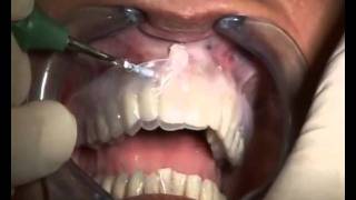 Ivoclar Vivadent - Temporary Restoration