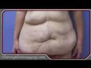 Tummy Tuck & Liposuction in San Antonio / Austin