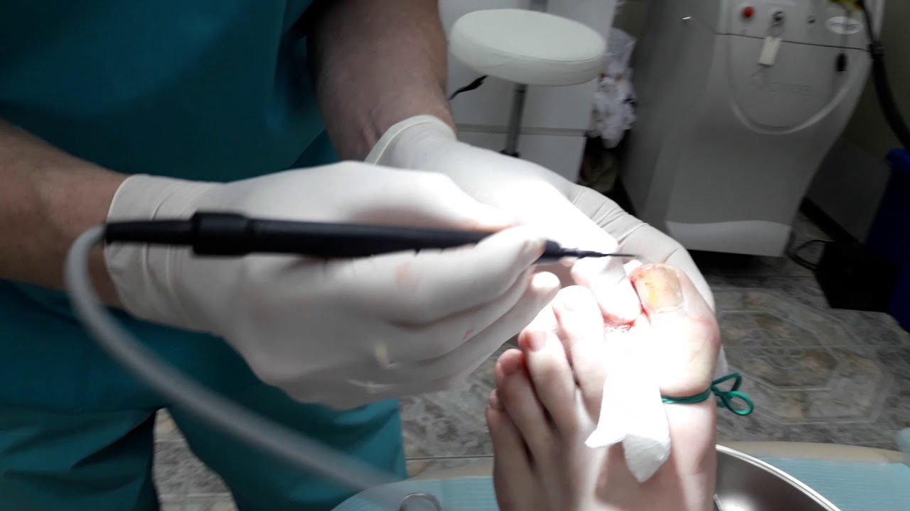 Вросший ноготь. Краевая резекция с применением радиоволны. - YouTube