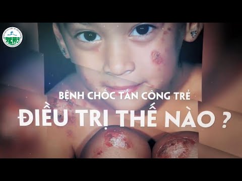 Video: Cách Chữa Mụn Rộp ở Trẻ Em