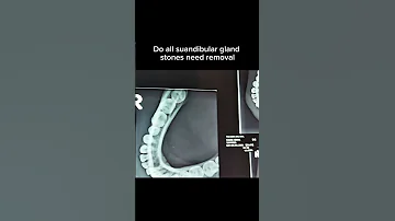 X Ray Floor Of Mouth Occlusal View Showing Tiny Submandibular Sialolithiasis 