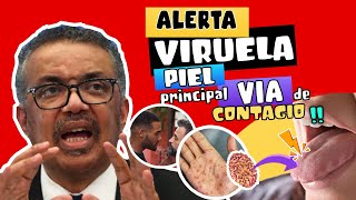 ALERTA  ⚠️ INVESTIGACIÓN REVELA PRINCIPAL VÍA DE TRANSMISIÓN DE VIRUELA DEL MONO ???