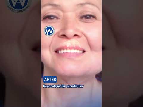 ¡Increíble transformación de mandíbula! Vea cómo la reconstrucción de mandíbula cambia vidas en Wintergerst