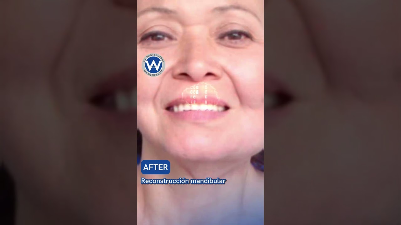Amazing Jaw Transformation! See how jaw reconstruction changes lives at Wintergerst. 🌟