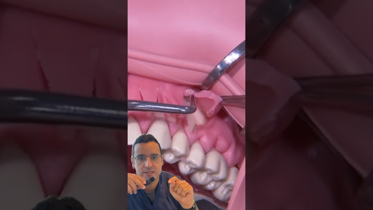 GREFFE de GENCIVE dentaire avec prélèvement au palais