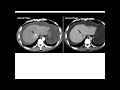 Dr. Baki, biliary zoom 03, surgery made easy for undergraduate students