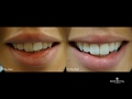 Invisalign, Teeth - Whitening and Composite Bonding