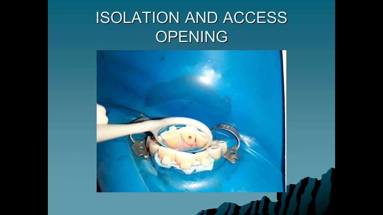 Management of horizontal fracture of a root