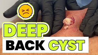 DEEP BACK CYST