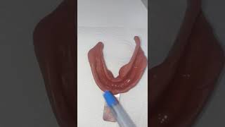 Visit 1: Lower primary impressions for dentures: Stock tray limitations, corrections.