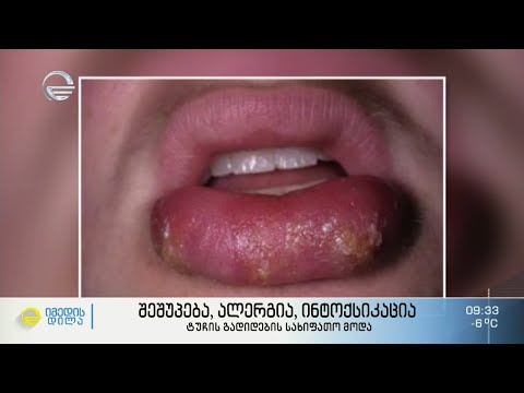 ტუჩის გადიდების სახიფათო მოდა და პლასტიკური ქირურგის, კონსტანტინე სულამანიძის, რჩევები